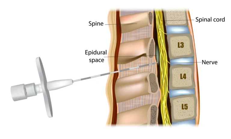 Epidural in Labor
