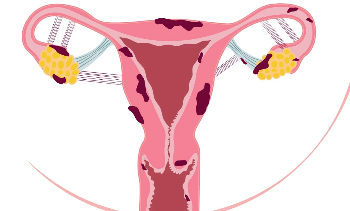 Endometriosis: Symptoms, Genetic Causes, Diagnosis