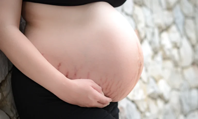 Overdue Pregnancy, Post-Term Pregnancy